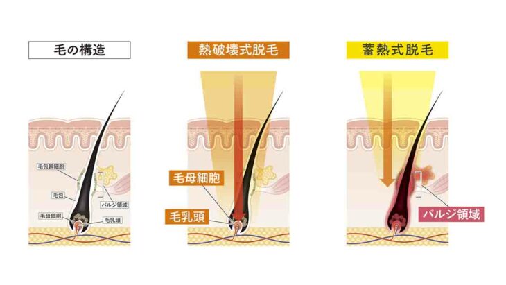 熱破壊式か蓄熱式かにこだわる